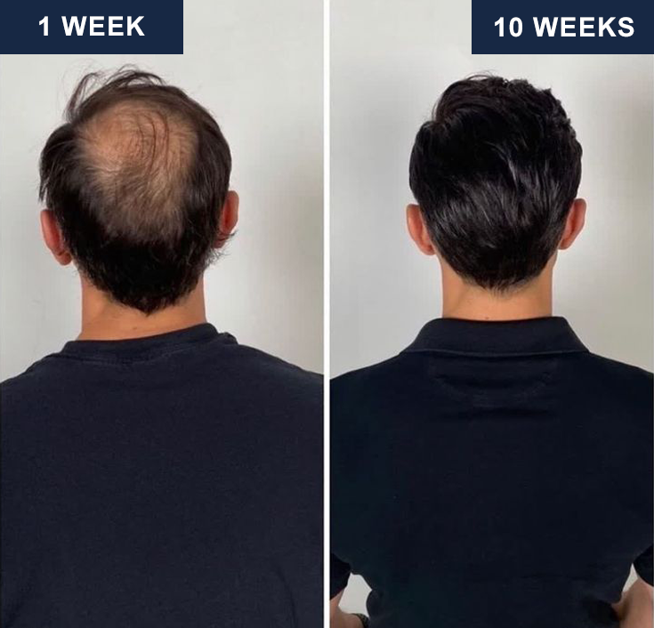 Serene Hair Regrowth System