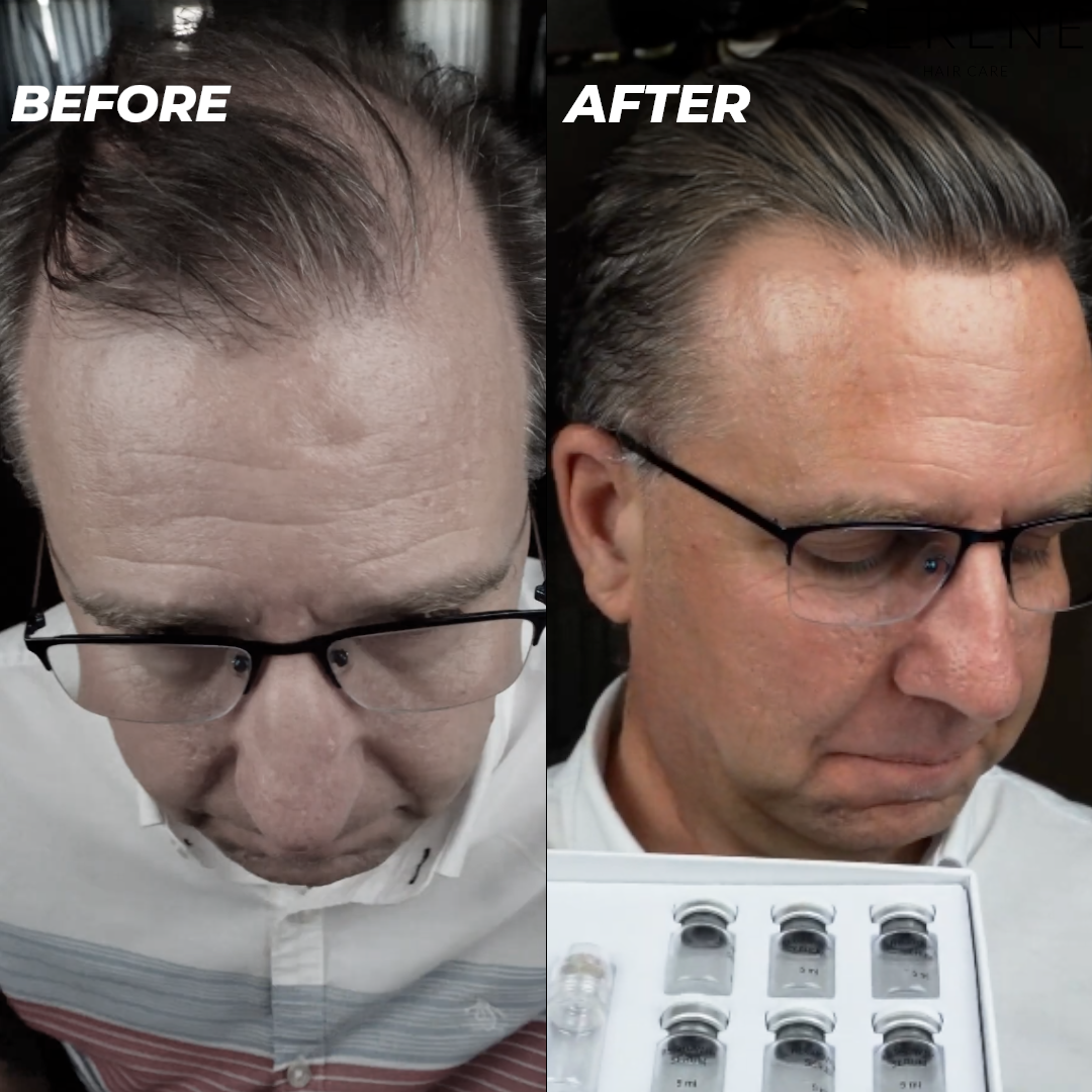 Serene Hair Regrowth System