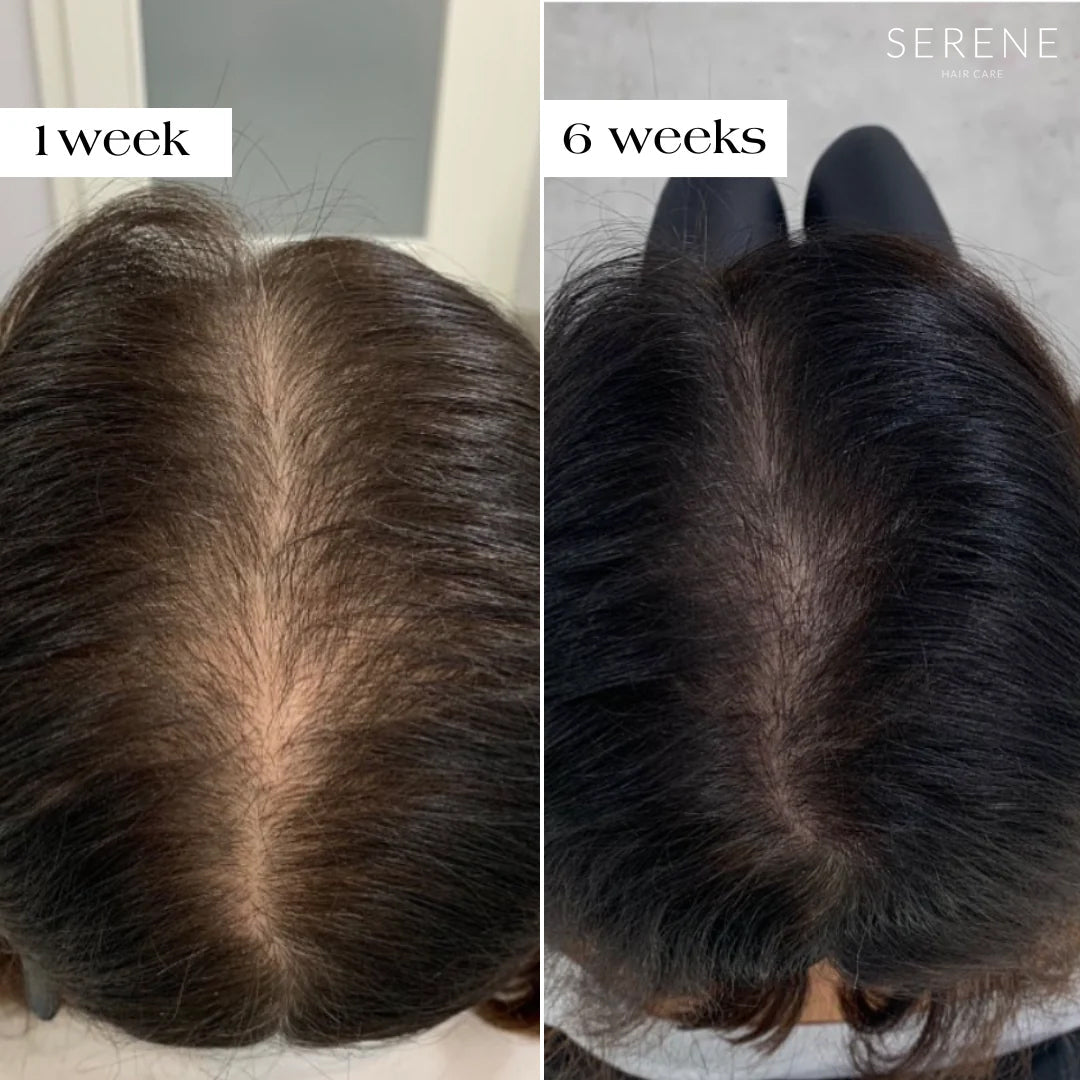 Serene Micro Infusion Regrowth System