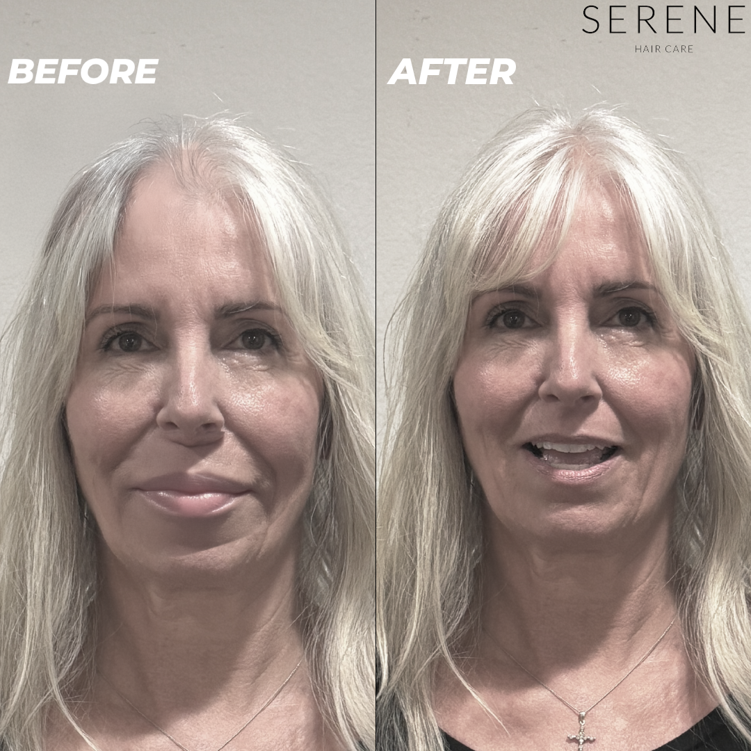 Serene Micro Infusion Regrowth System