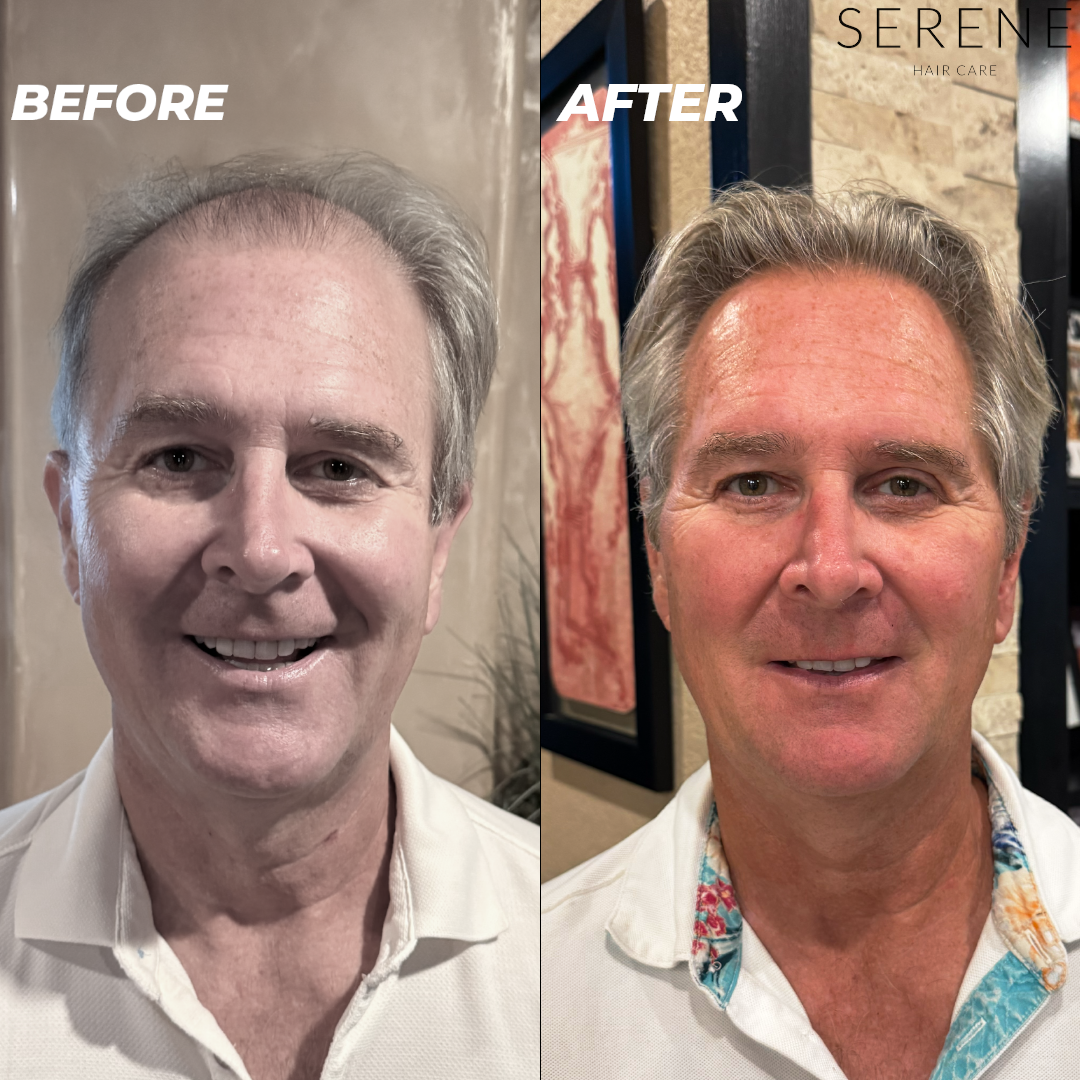 Serene Hair Regrowth System